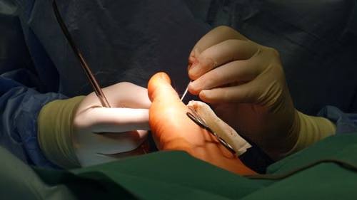 Unique Incision Surgery in Houston Combines Cosmetic Benefits with Effective Foot Treatment